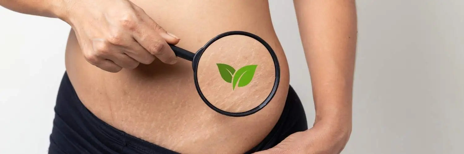 Vergetures : quelles solutions naturelles pour prévenir et atténuer les marques ?