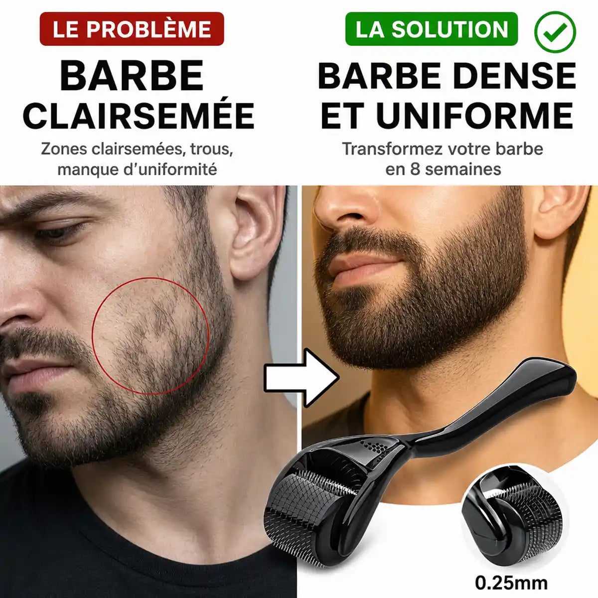 Dermaroller barbe 0,25mm avant-après : barbe clairsemée transformée en barbe dense et uniforme en 8 semaines
