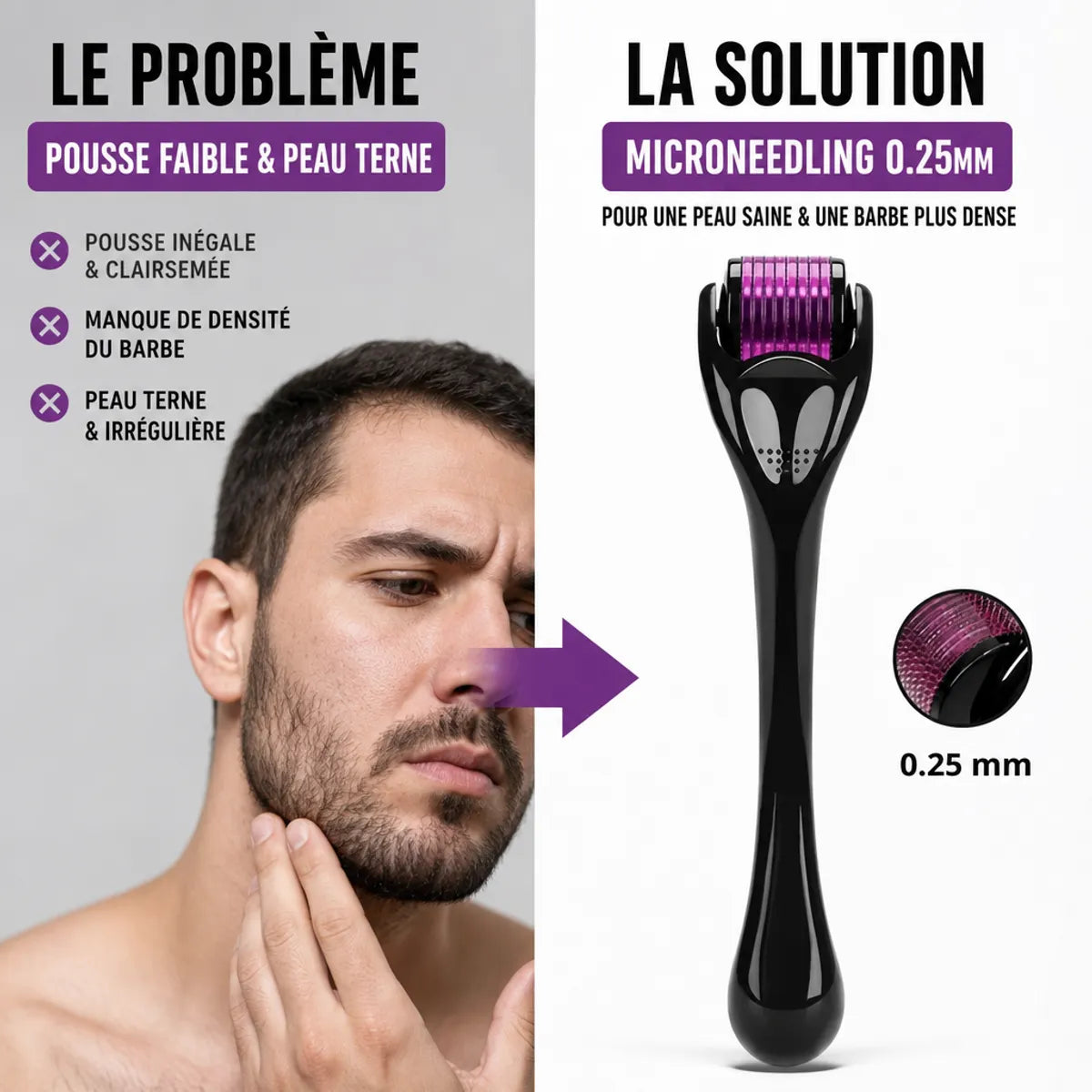Dermaroller barbe 0,25mm noir violet - solution microneedling pour barbe et peau