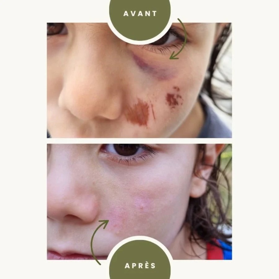 Résultats sur le visage suite à l'application du gel originel bio à l'aloé vera de Naturaloé