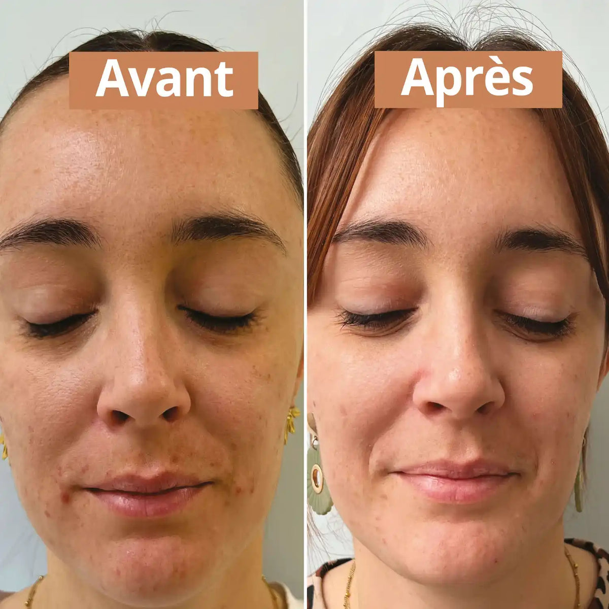 Photo avant et après utilisation du sérum visage purifiant de 30 ml de la marque Comme Avant