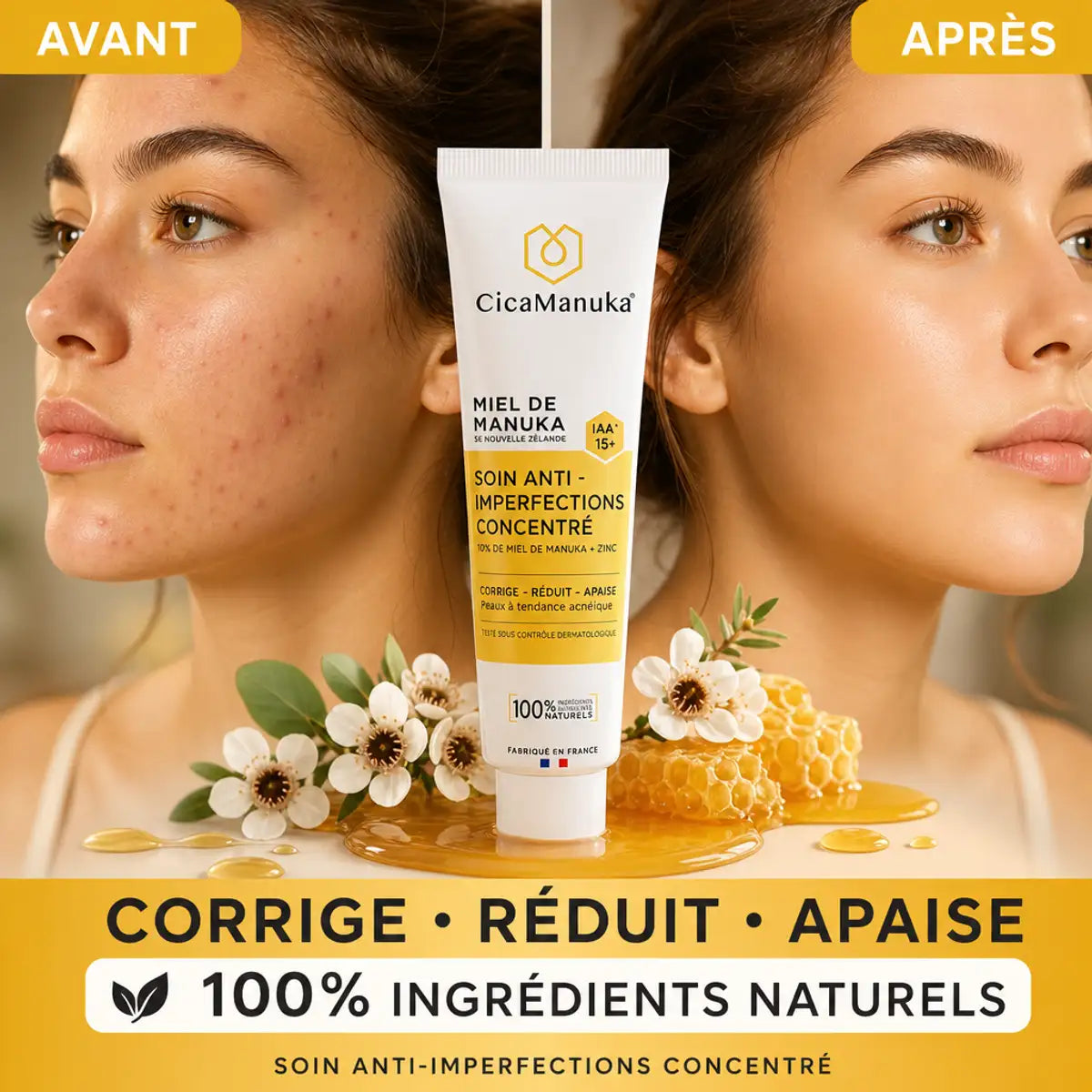 Avant/après soin anti-imperfections miel de manuka IAA15+ - résultats visibles sur peau acnéique